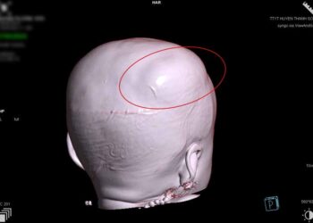 Sập cánh cổng nhà khiến bé gái 15 tháng tuổi ở Thanh Sơn bị chấn thương sọ não